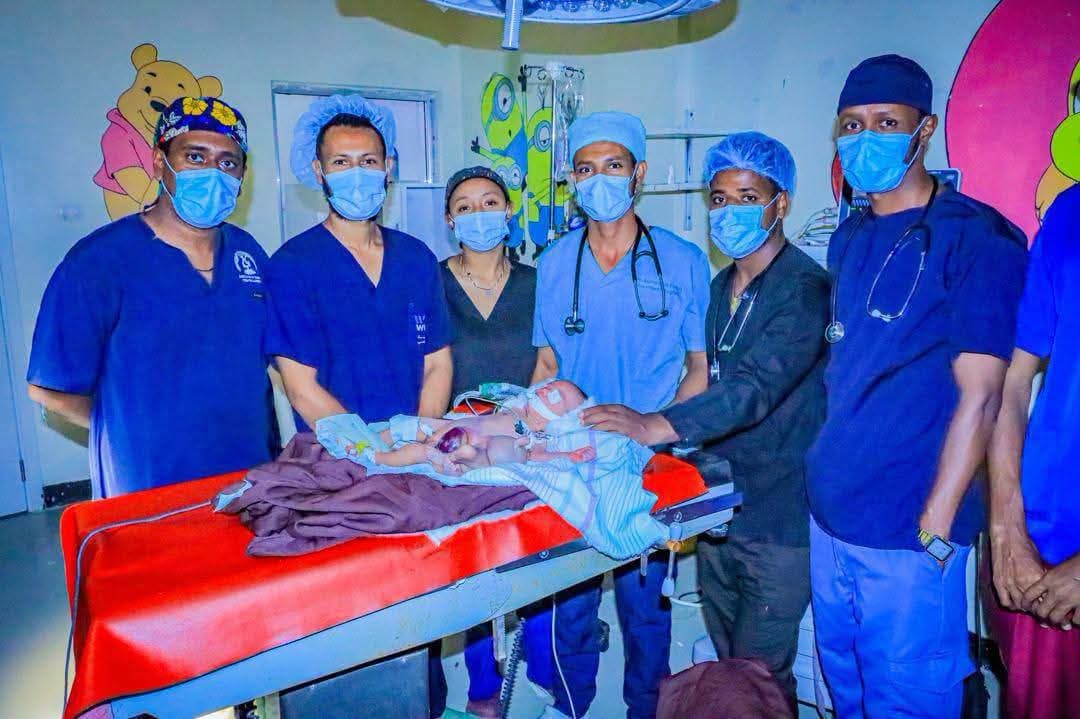 إثيوبيا: أطباء في الإقليم الصومالي ينجحون في فصل توأم سيامي في جراحة نادرة